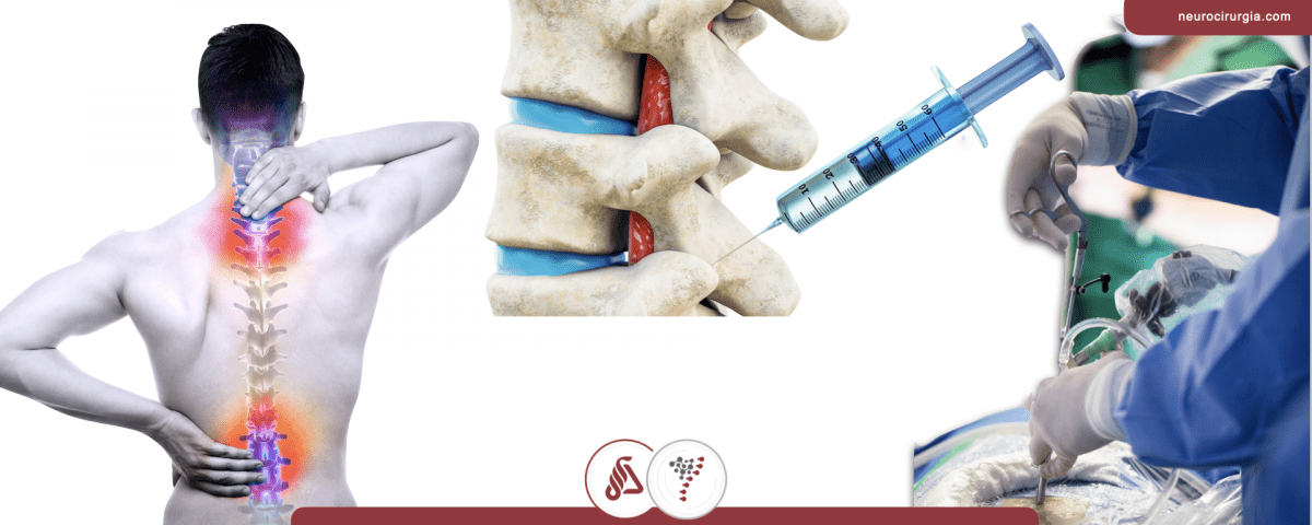 Rizotomia facetária por endoscopia