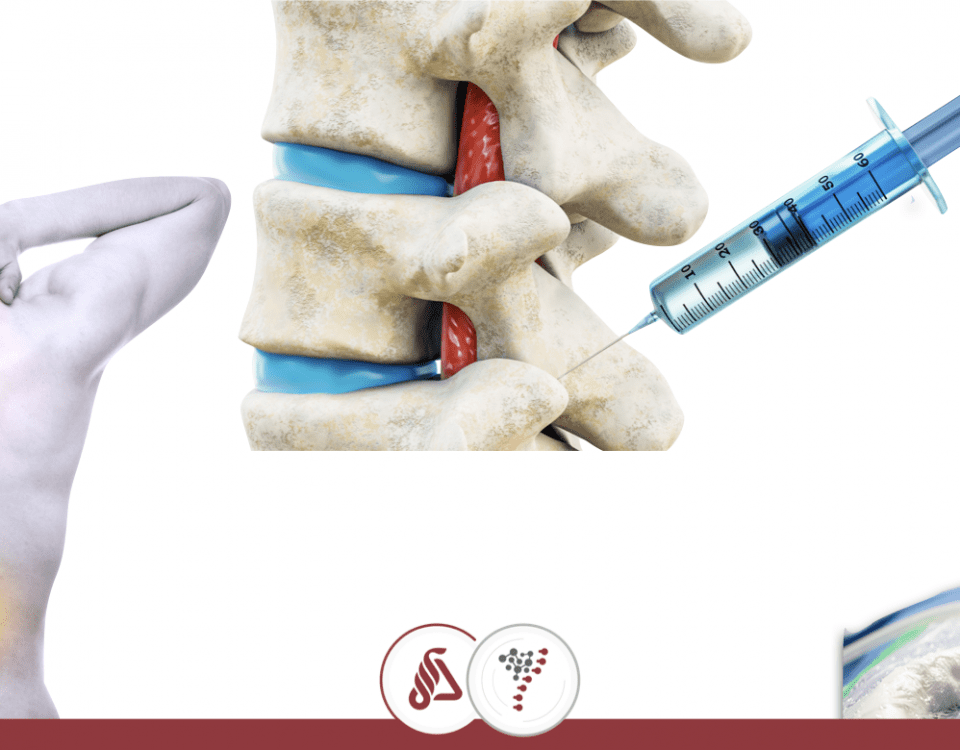 Rizotomia facetária por endoscopia