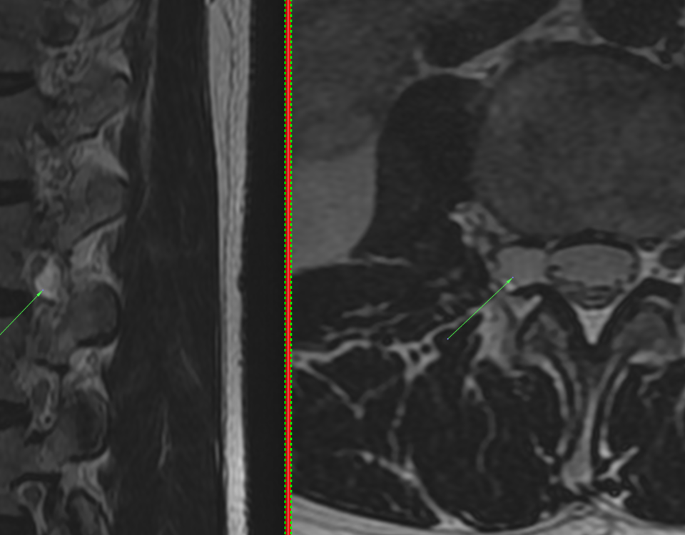 Cisto perirradicular ou sito de Tarlov, lesão na coluna vertebral.